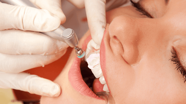Professional teeth clean at the dentist