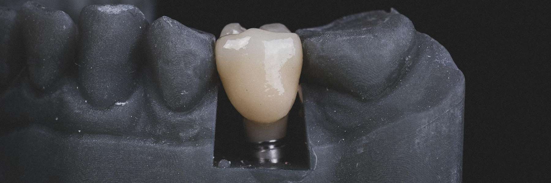 Tooth Replacements – Dental Implants, Bridges and Dentures | Dentist