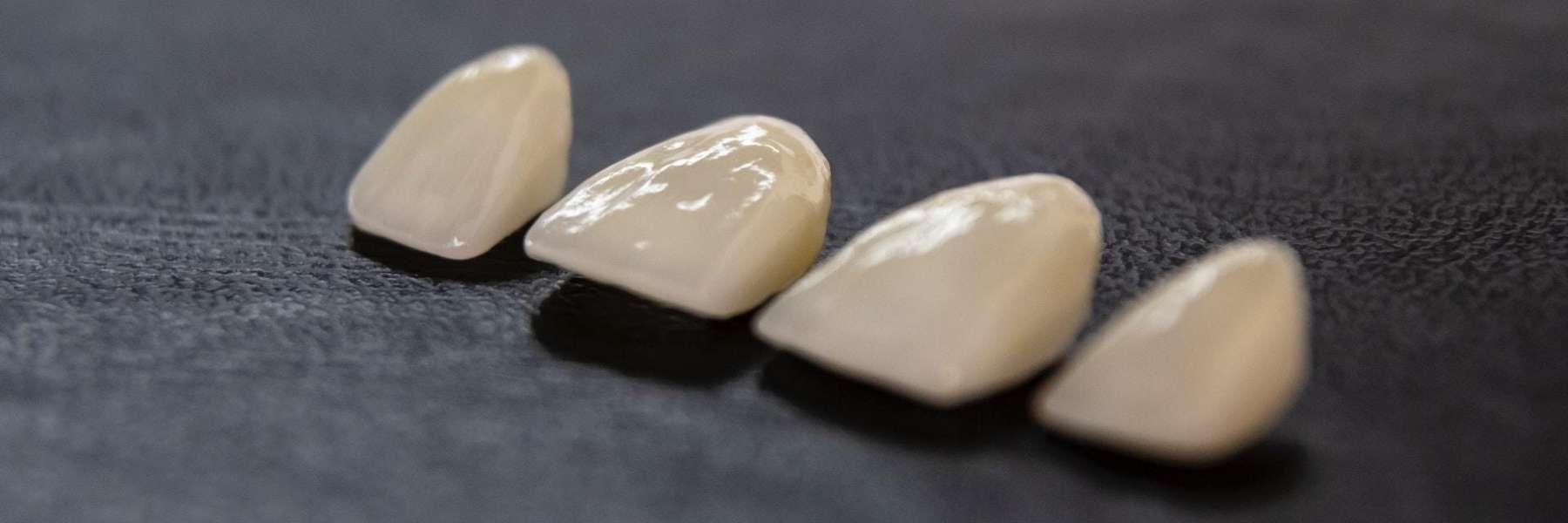 Tooth Restorations – Fillings, Inlays, Onlays, Crowns | Dentist
